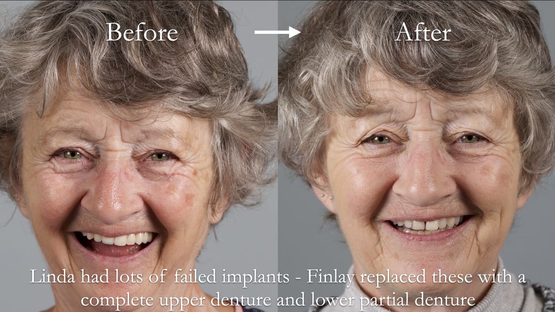 Helping Linda out of a "desperate" situation of failed dental implants