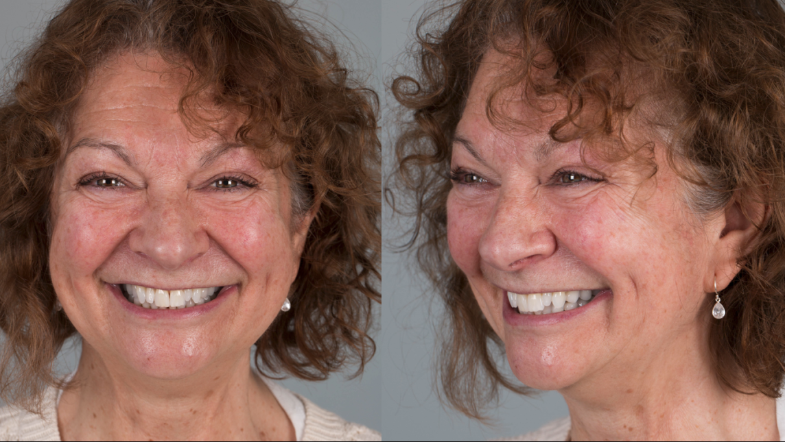 Angela loves her new smile by Finlay and Rowan