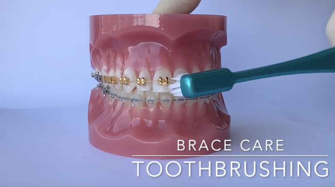 TOOTHBRUSHING FOR BRACES - the required method for brushing your brace