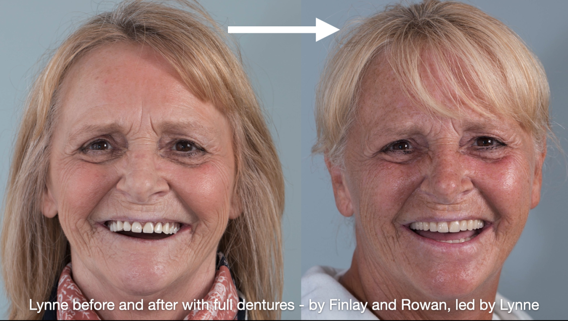 Lynne's complete (full) dentures by Finlay