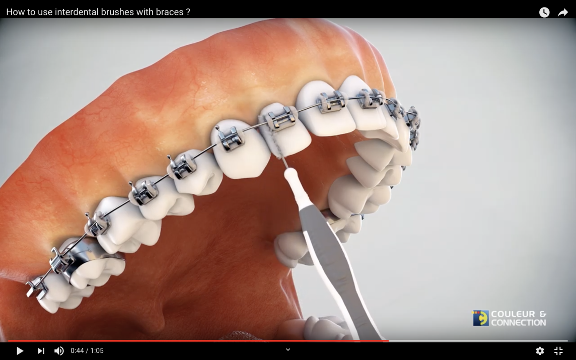 Keep using interdental brushes for your braces