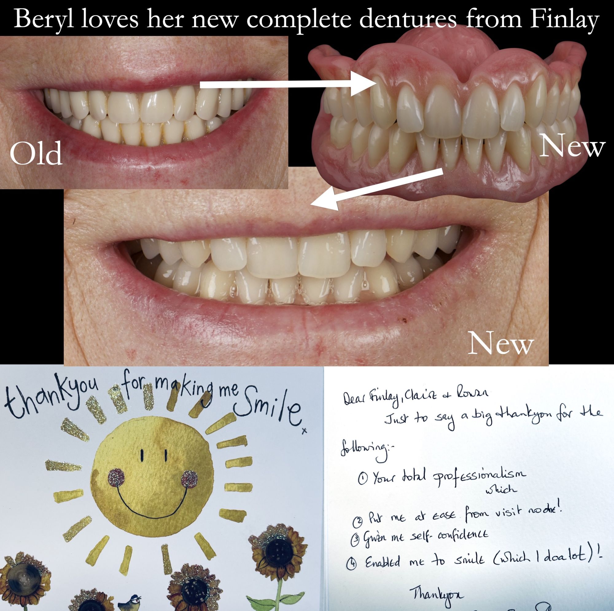 Beryl loves her new complete dentures from Finlay